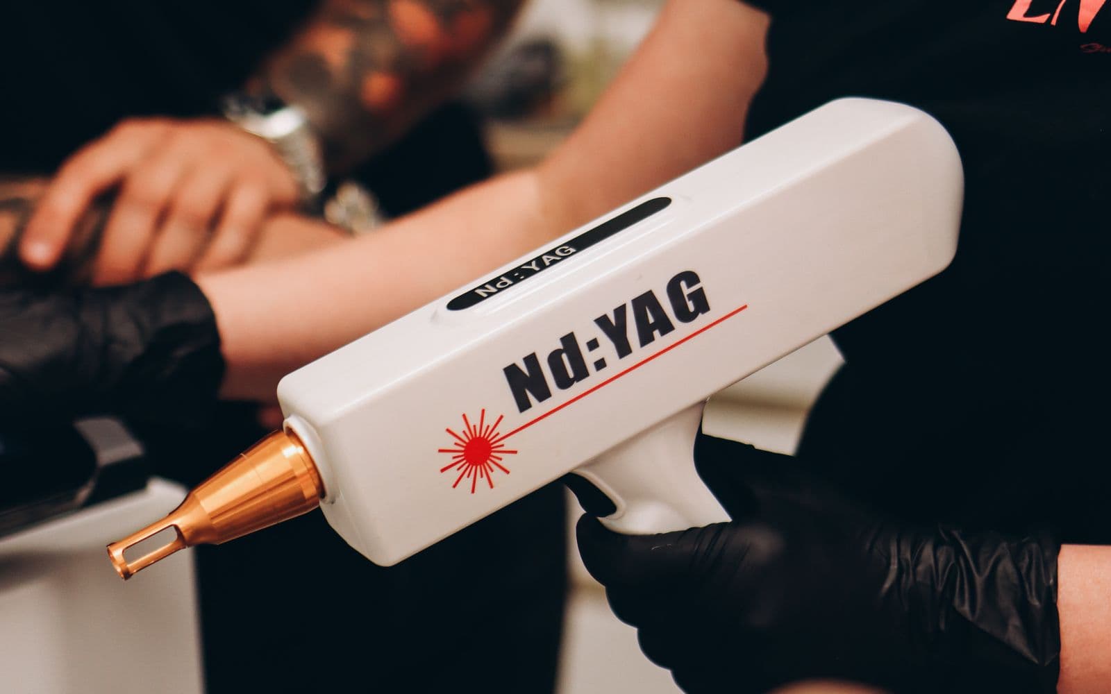 Remoção de Tatuagens e Peeling de Carbono
